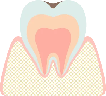 初期の虫歯（白い斑点・黒ずみ）のイラスト