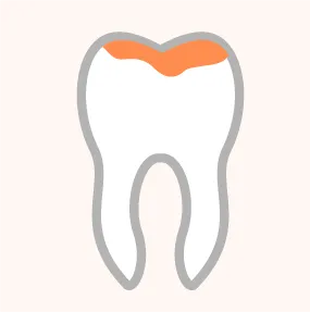 歯が溶けていく（この時点では再生可能）のイラスト