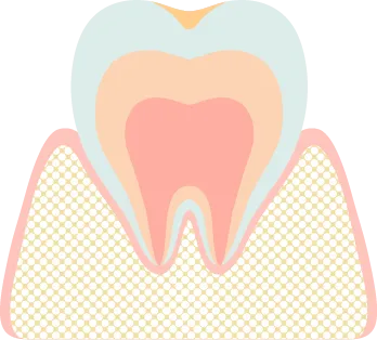 虫歯になる前段階（初期症状）のイラスト