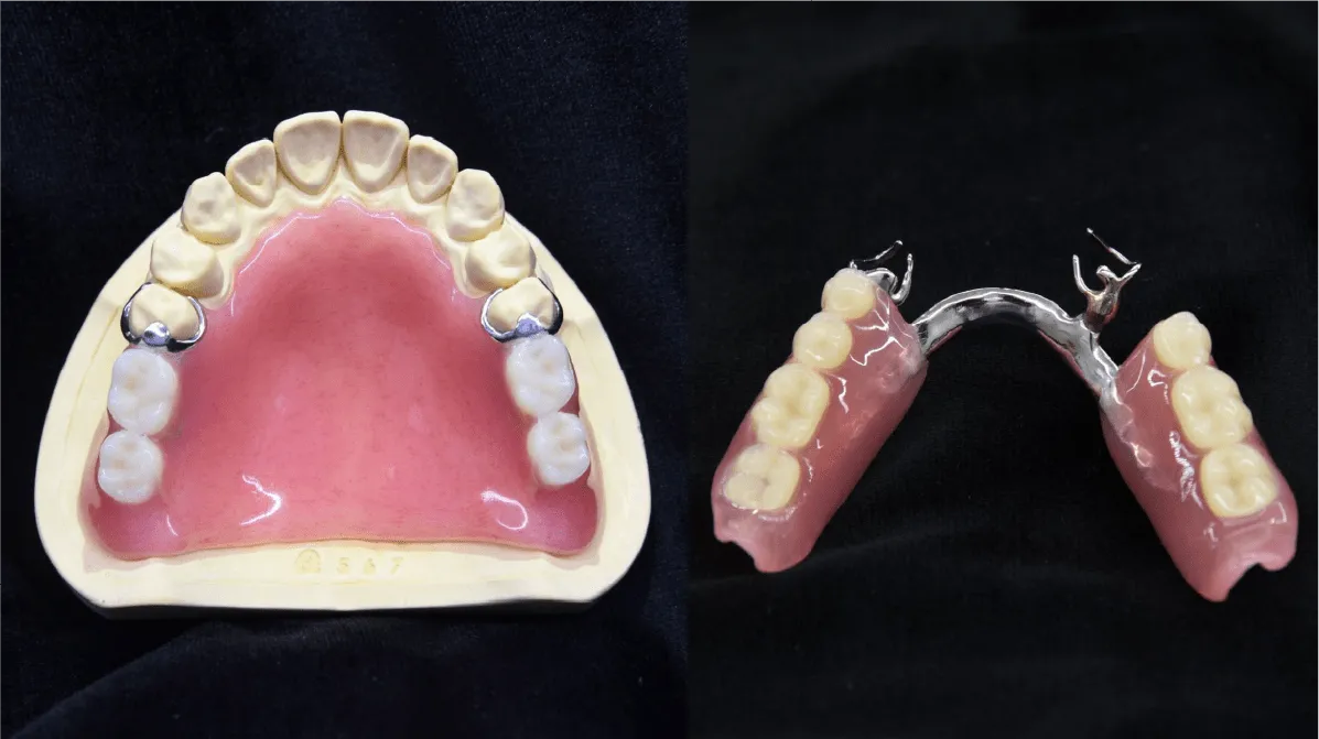 保険診療で受けられる入れ歯・義歯の写真