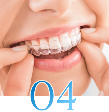 インビザラインのメリット4