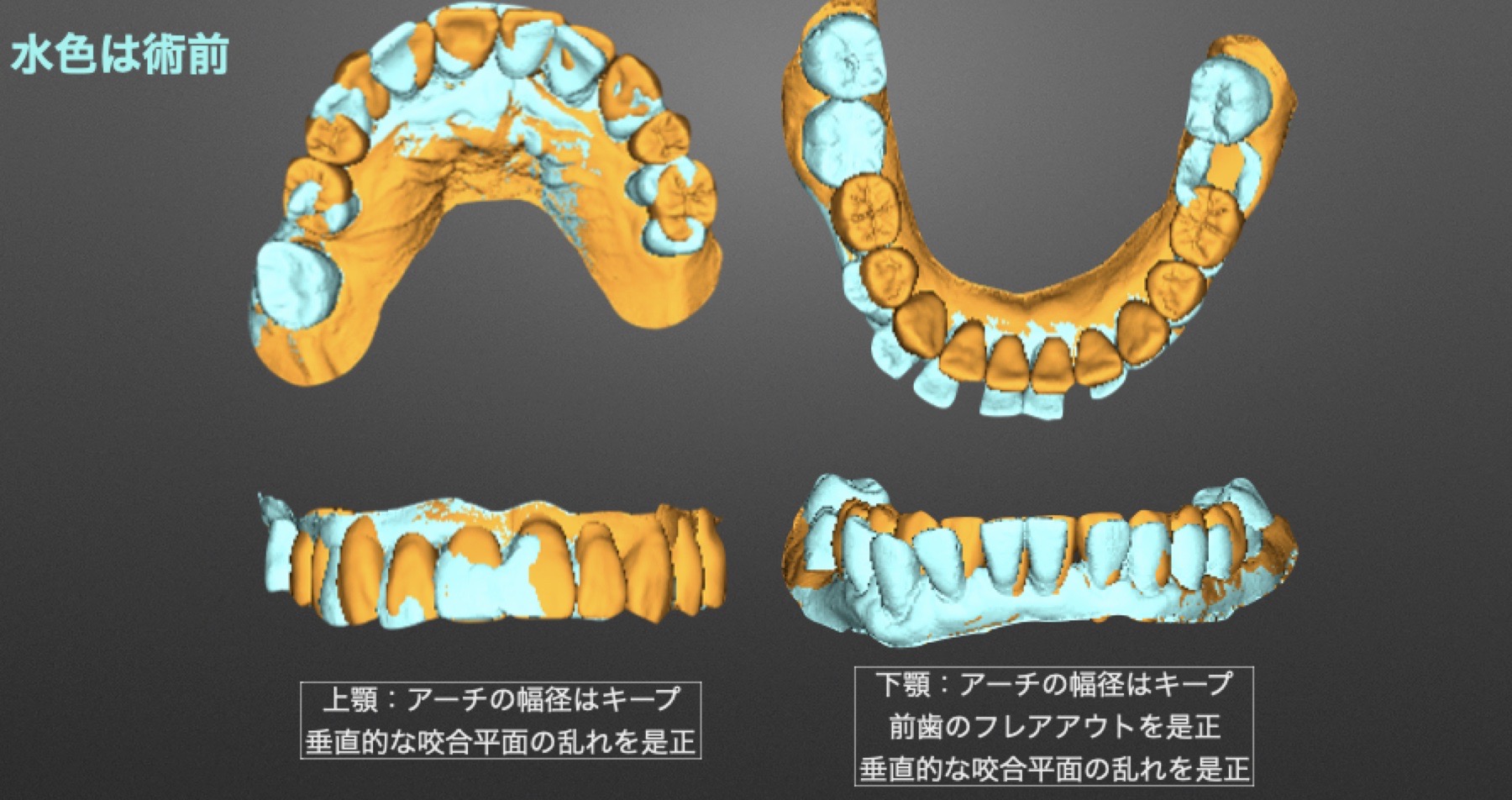 前歯位置と噛み合わせを検討したStraumann Pro Arch症例の診断用模型