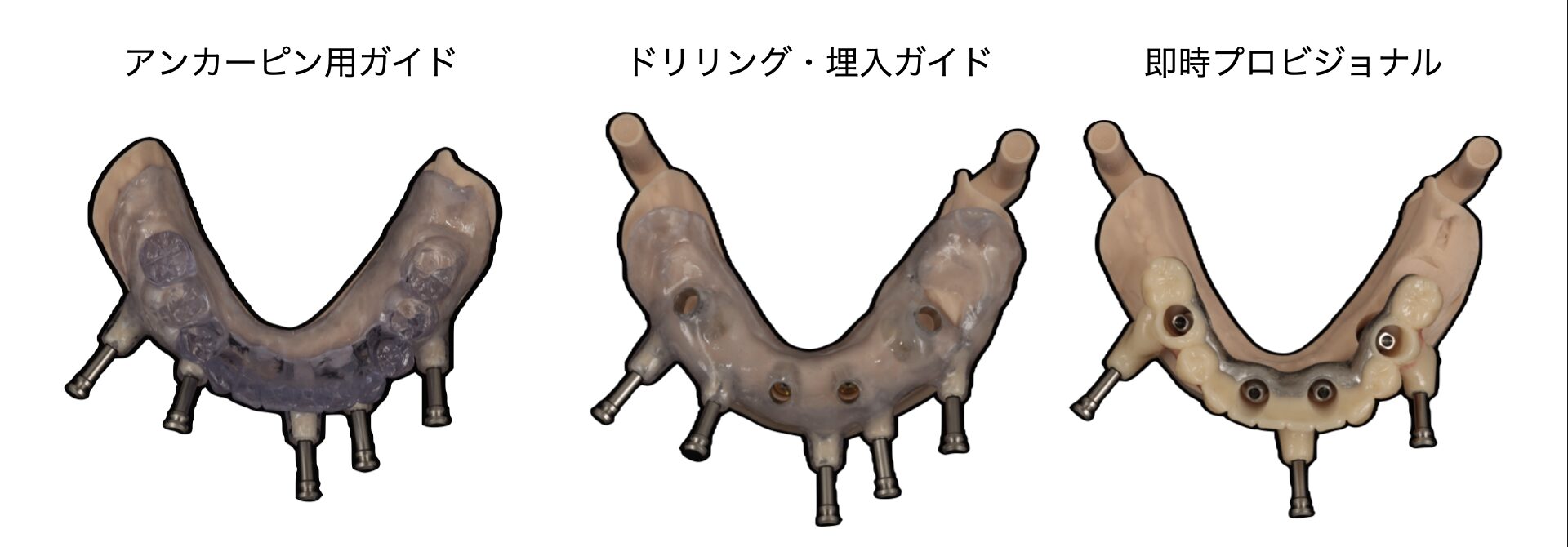 All-on-4手術に用いた3種類の装置