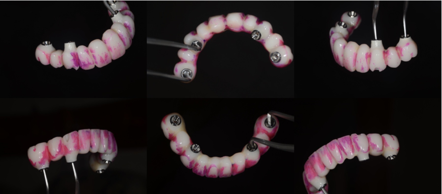 使用後の固定式仮歯を染め出してプラークの付着部位を確認した写真