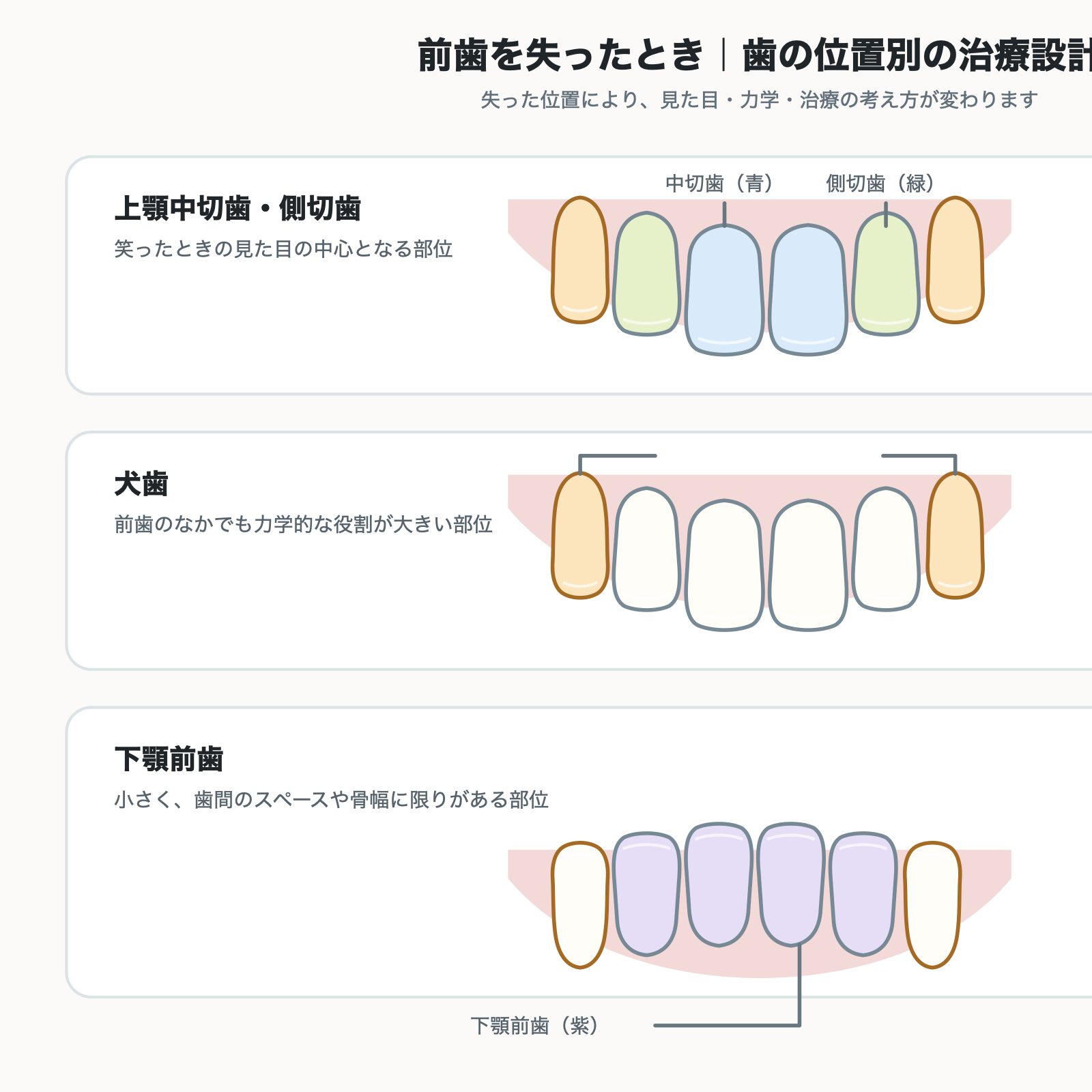前歯を失ったときの歯の位置別治療設計図